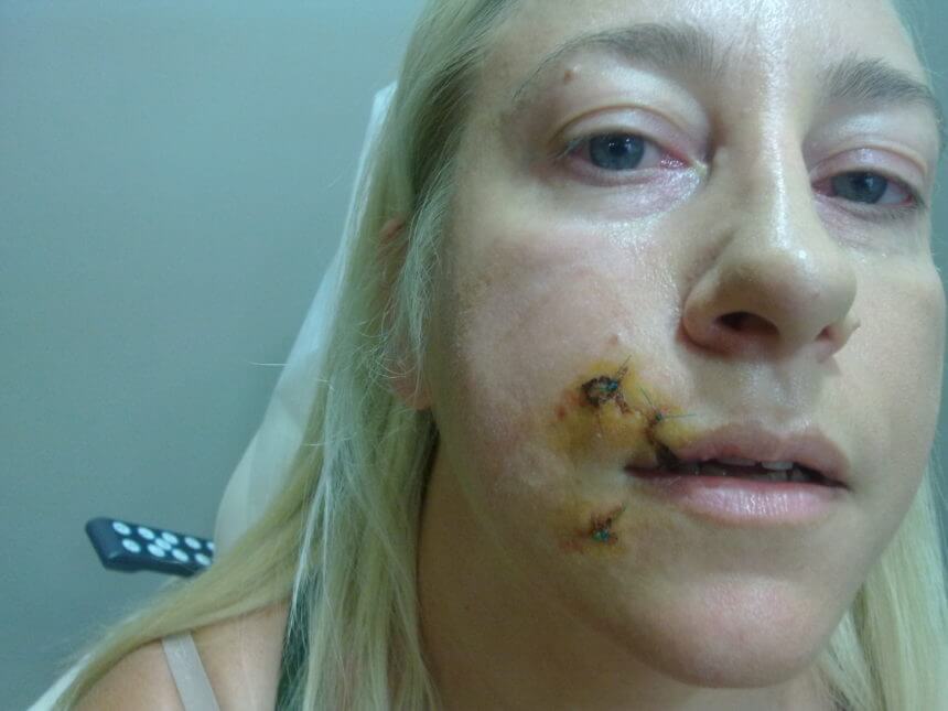 Η συγκλονιστική εξομολόγηση της Πηνελόπης που παραμορφώθηκε από δάγκωμα σκύλου