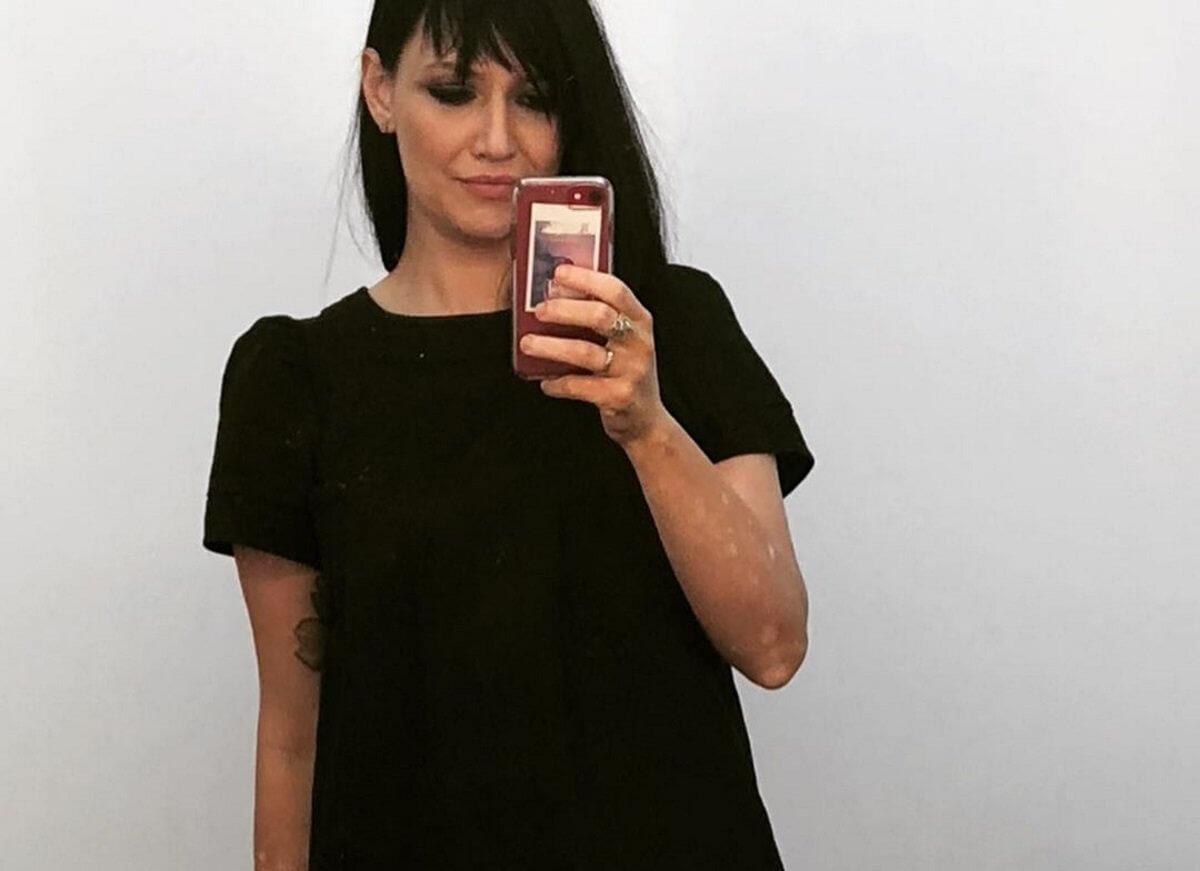 Η Αθηναΐς Νέγκα ποζάρει με μαγιό και δείχνει τα σημάδια της λεύκης στο κορμί της