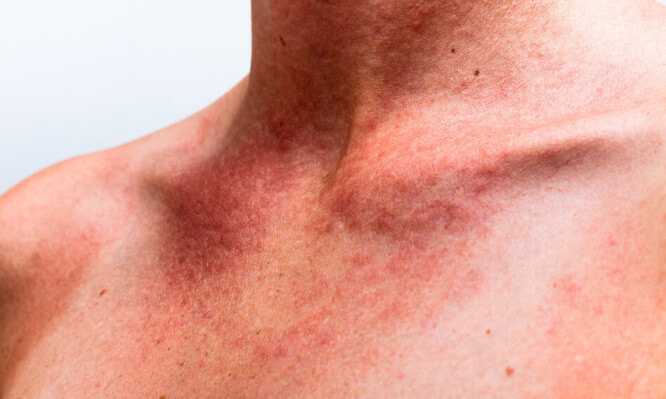 Πώς θα καταλάβετε αν ένα ηλιακό έγκαυμα είναι δηλητηρίαση από τον ήλιο