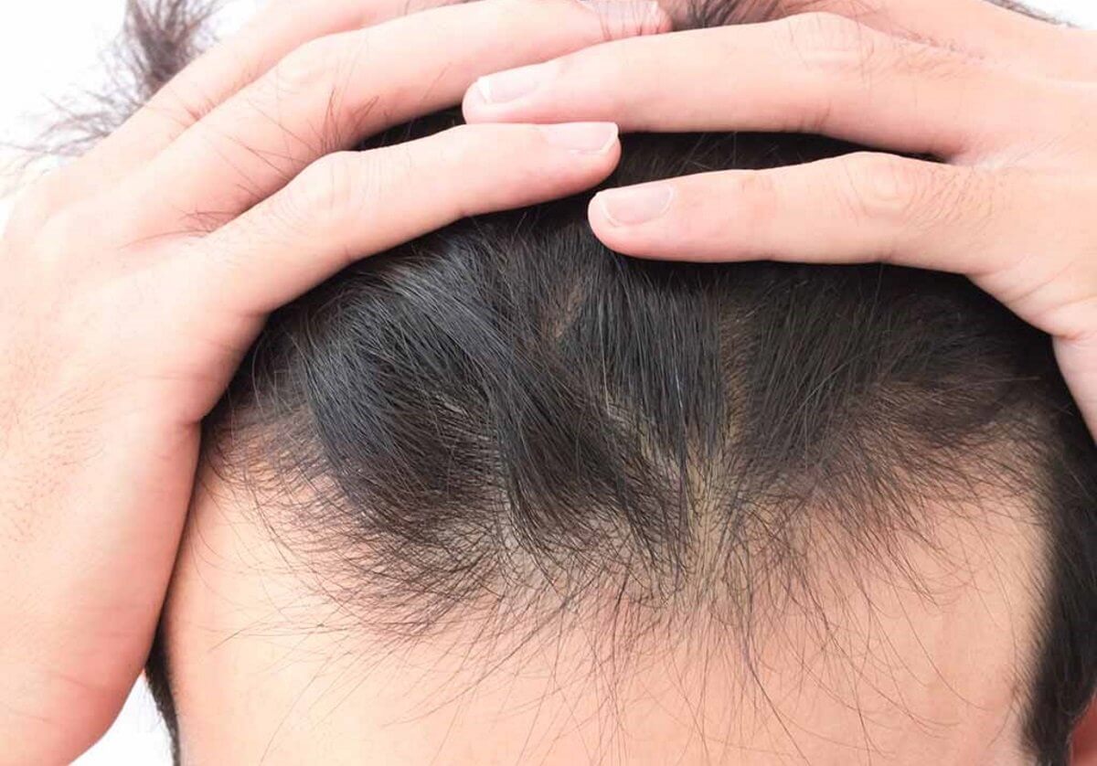 Τριχόπτωση: Ο απροσδόκητος λόγος που προκαλεί απώλεια μαλλιών