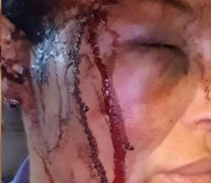 Φωτογραφίες σοκ της κακοποιημένης Μαντώς Τζαβάρα από τον μπασκετμπολίστα σύντροφό της!