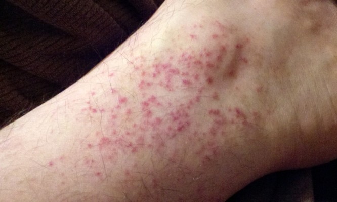 Εξάνθημα από τον ιδρώτα – Δείτε τι να κάνετε για να μειώσετε τις επιπτώσεις