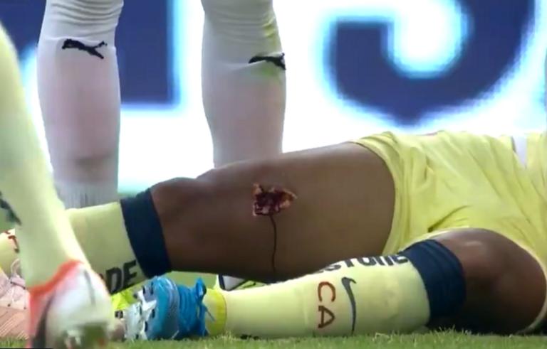 Ανατριχιαστικός τραυματισμός! Του άνοιξε τρύπα στο πόδι – video
