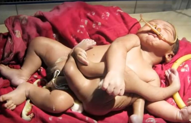 Απίστευτο! Μωρό γεννήθηκε με 4 πόδια και 3 χέρια! video