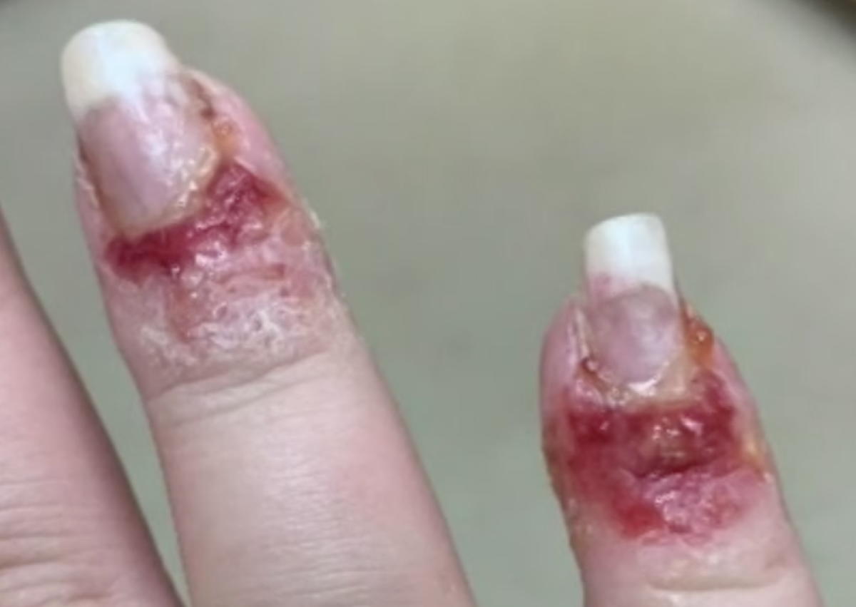 Έκανε μανικιούρ με σκόνη κι έπαθε μόλυνση στα δάχτυλα – Δείτε τι μπορεί να σας συμβεί!