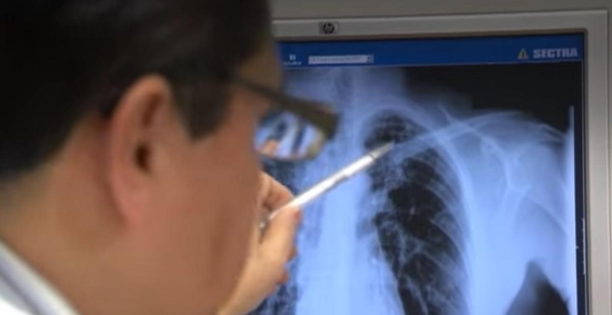 Φυματίωση: “Καμπανάκι” χτυπάνε οι πνευμονολόγοι στην Ελλάδα!
