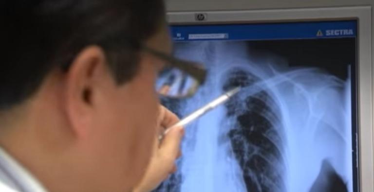Φυματίωση: “Καμπανάκι” χτυπάνε οι πνευμονολόγοι στην Ελλάδα!
