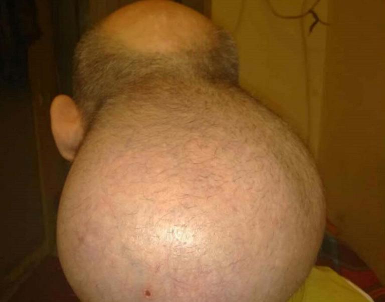 Σέρρες: Κρατούμενος με όγκο στο κεφάλι που μεγαλώνει συνεχώς! Το ξέσπασμα και η κραυγή αγωνίας του [pic, video]
