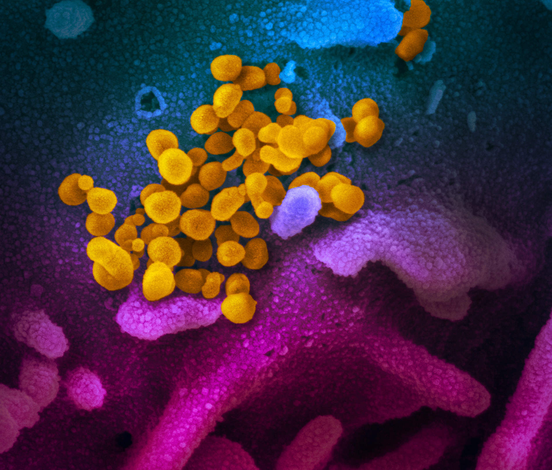 An undated scanning electron microscope image shows SARS-CoV-2 (yellow), also known as novel coronavirus, the virus that causes COVID-19, isolated from a patient in the U.S., emerging from the surface of cells (blue