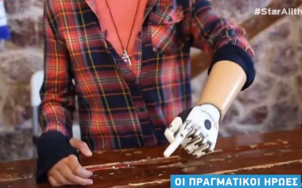 Συγκλονιστικό: Αυτή είναι η ιστορία της πρώτης γυναίκας με βιονικό χέρι στην Ελλάδα