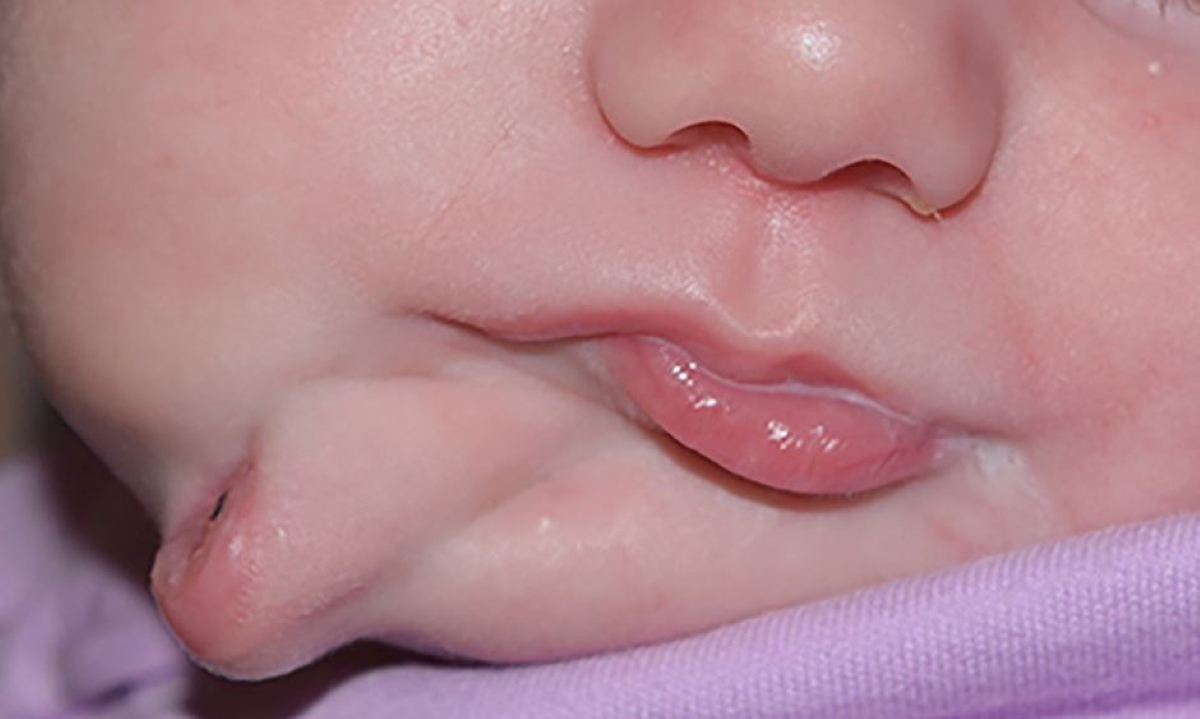 Γεννήθηκε μωρό με δύο στόματα! Δείτε εικόνες πριν και μετά την επέμβαση των γιατρών