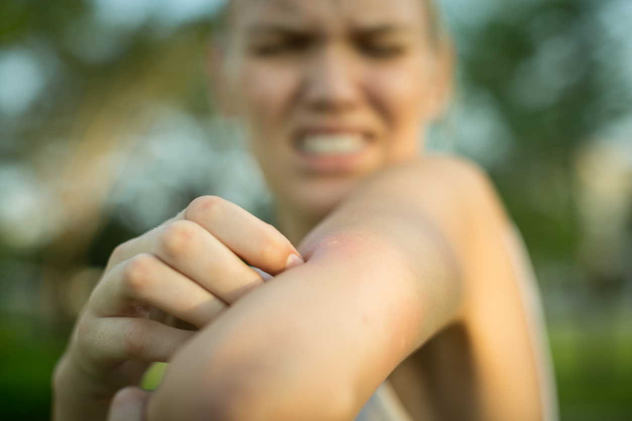 Τσιμπήματα κουνουπιών: Τι να κάνετε για να υποχωρήσουν γρήγορα