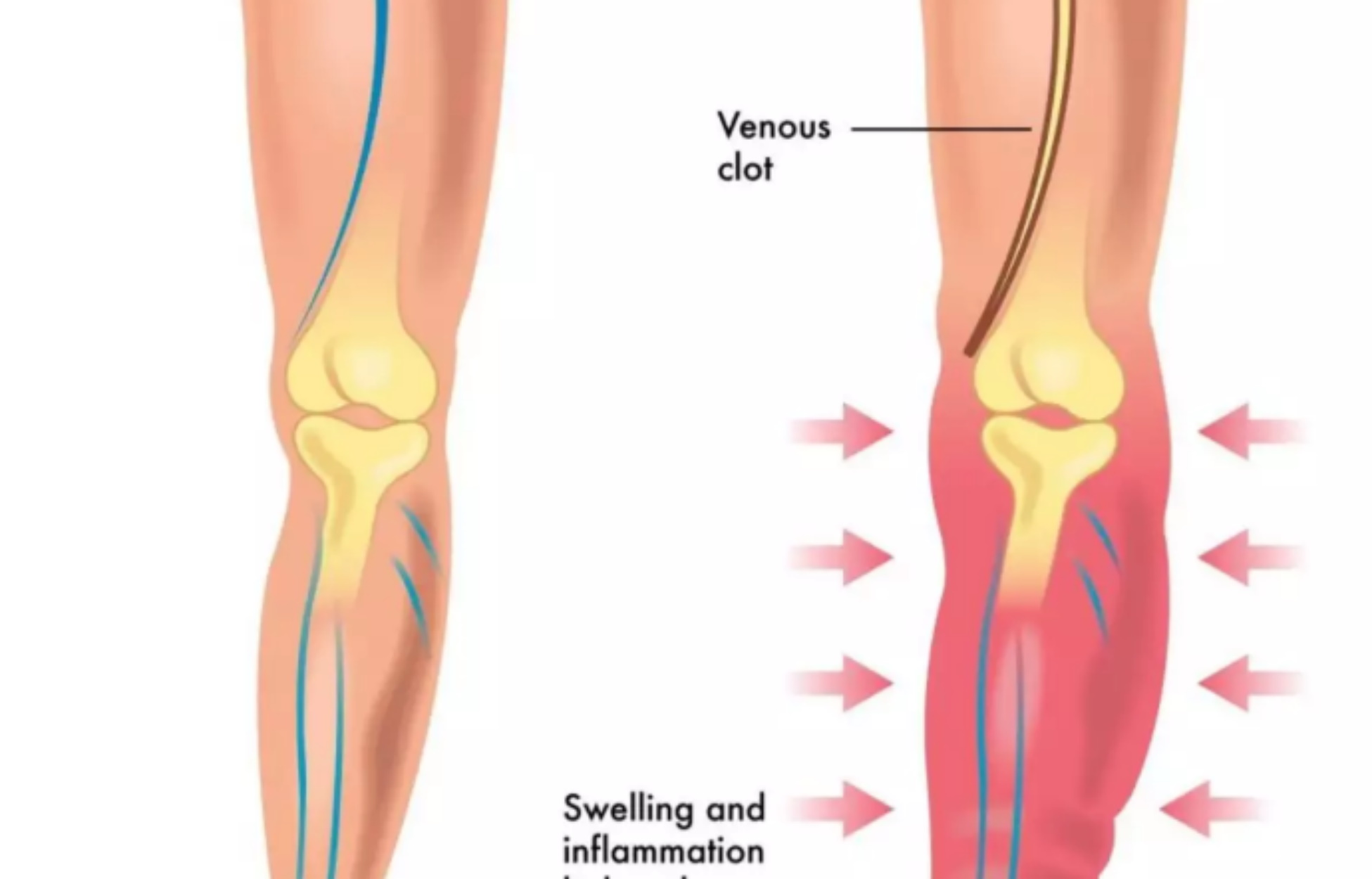 Φλεβική θρόμβωση: Ποιοι κινδυνεύουν από τον «σιωπηλό δολοφόνο»