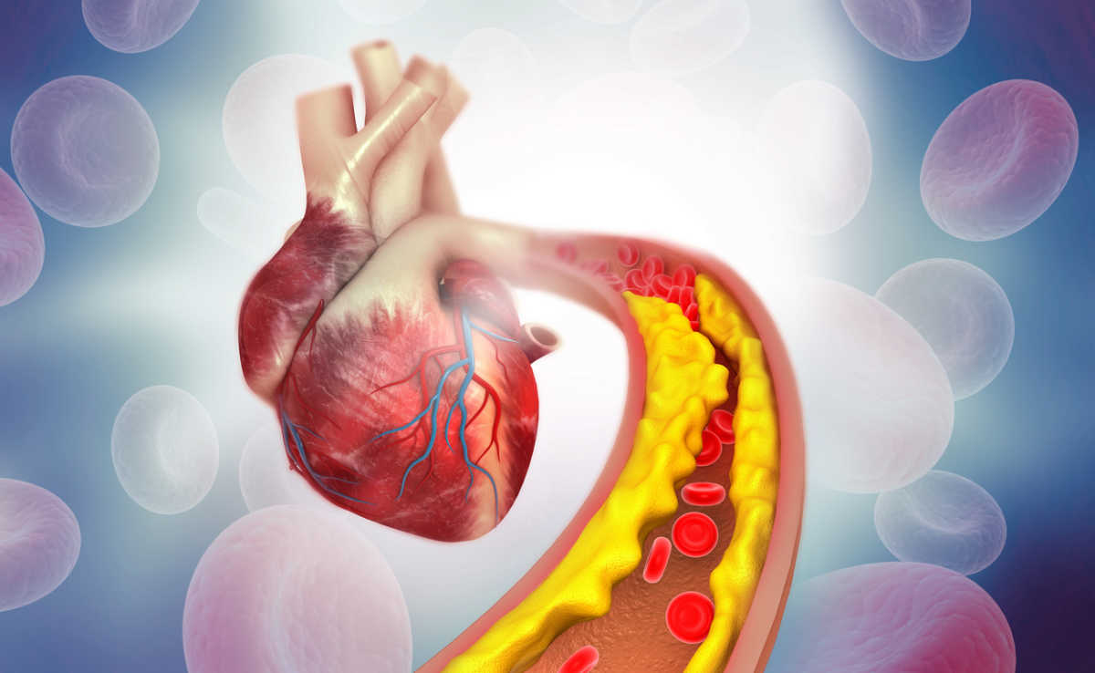 Τι ισχύει για τη χαμηλή «κακή» χοληστερίνη και τον καρδιαγγειακό κίνδυνο – Τι δείχνουν νέες έρευνες