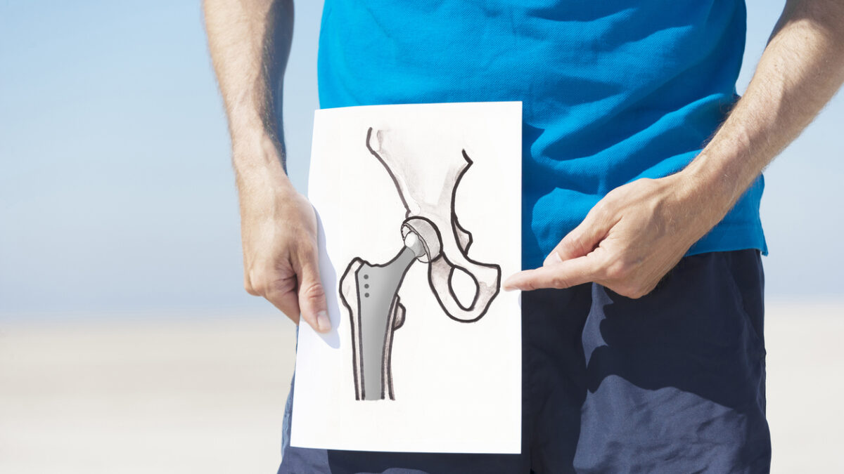 Drawing of a total hip-joint replacement. XXL size image.