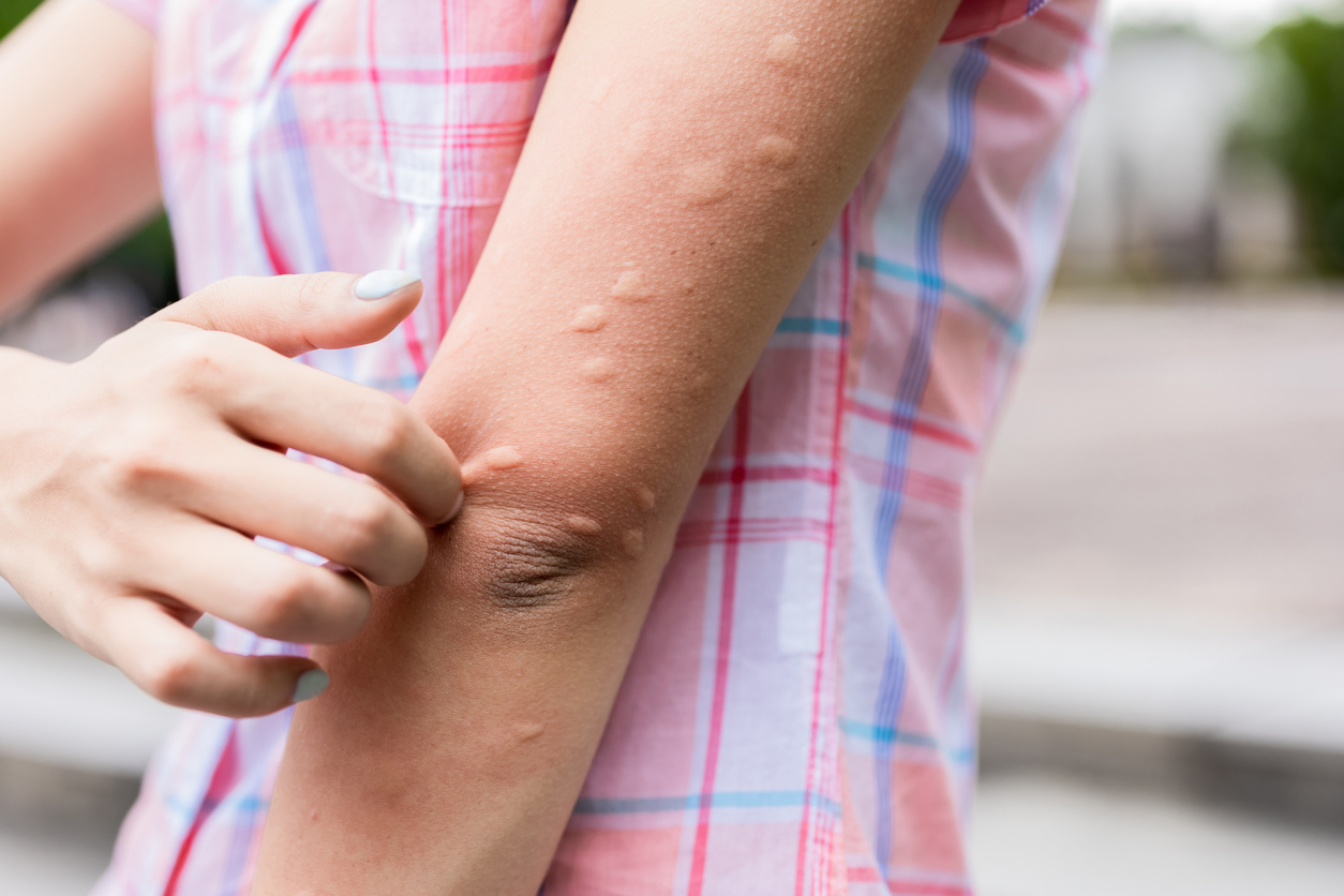 5 μυστικά για να μην σε τσιμπάνε τα κουνούπια