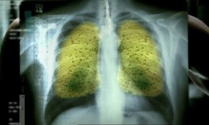 Ηλεκτρονικά τσιγάρα: Νέα ανησυχητικά ευρήματα για βλάβες στην υγεία από τα χημικά
