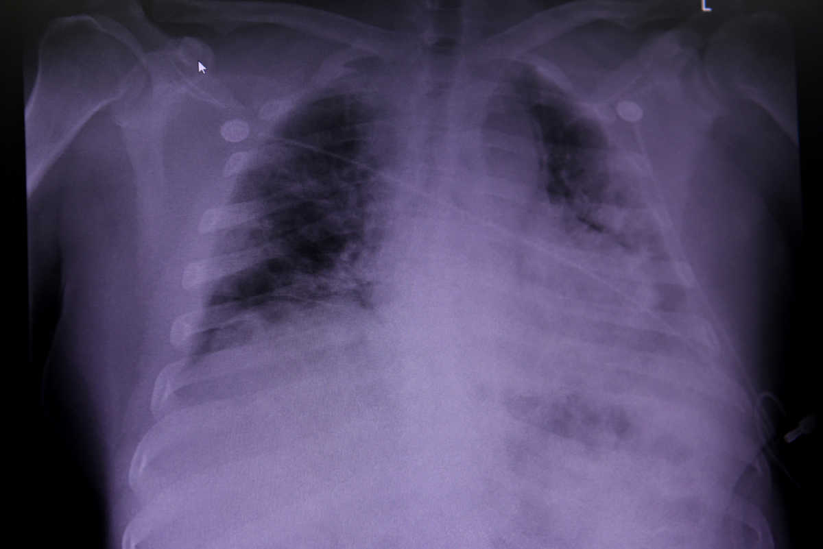 FILE PHOTO: An X-ray of a COVID-19 patient's lungs at United Memorial Medical Center in Houston, Texas, U.S., July 10, 2020.  REUTERS