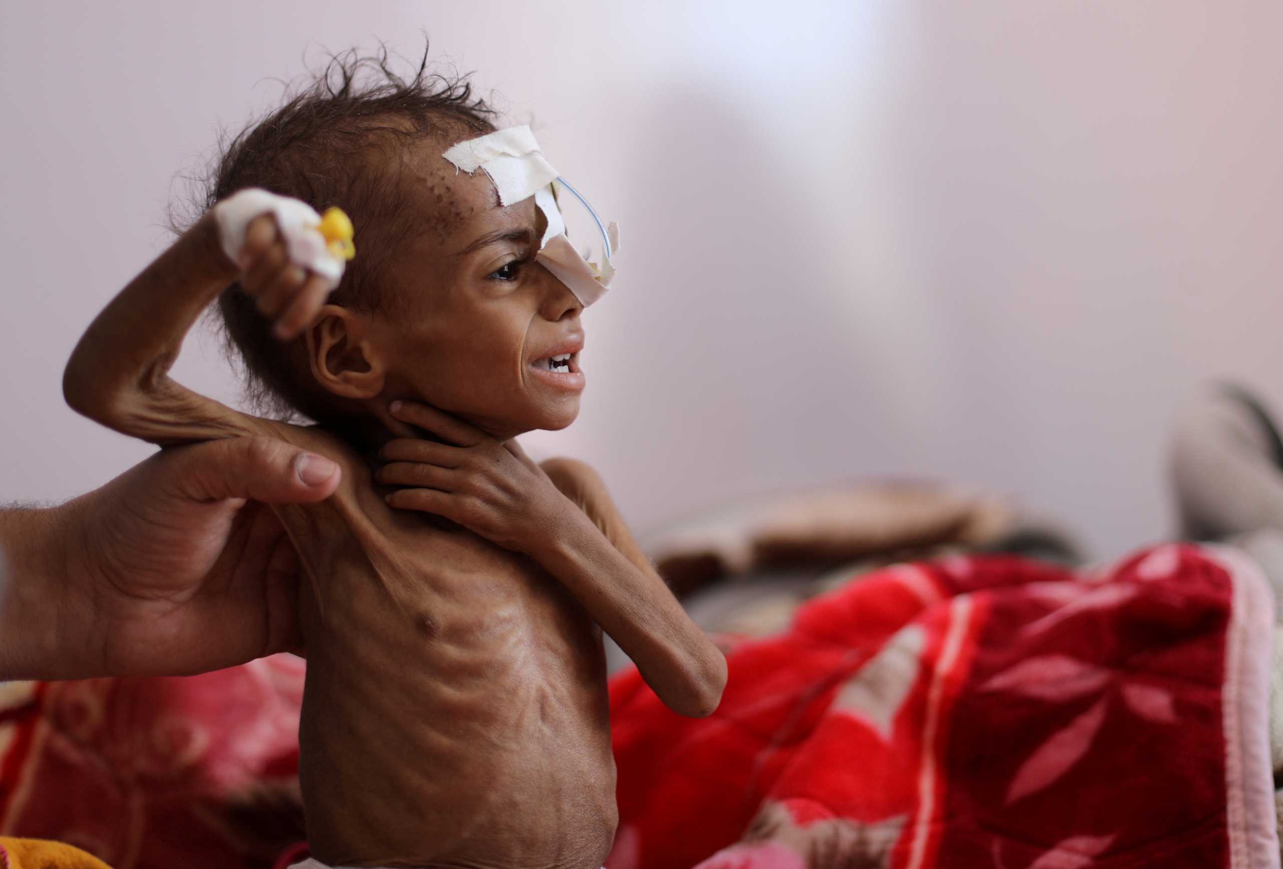FILE PHOTO: A nurse holds a malnourished girl at a malnutrition treatment wart of al-Sabeen hospital in Sanaa, Yemen October 27, 2020. REUTERS
