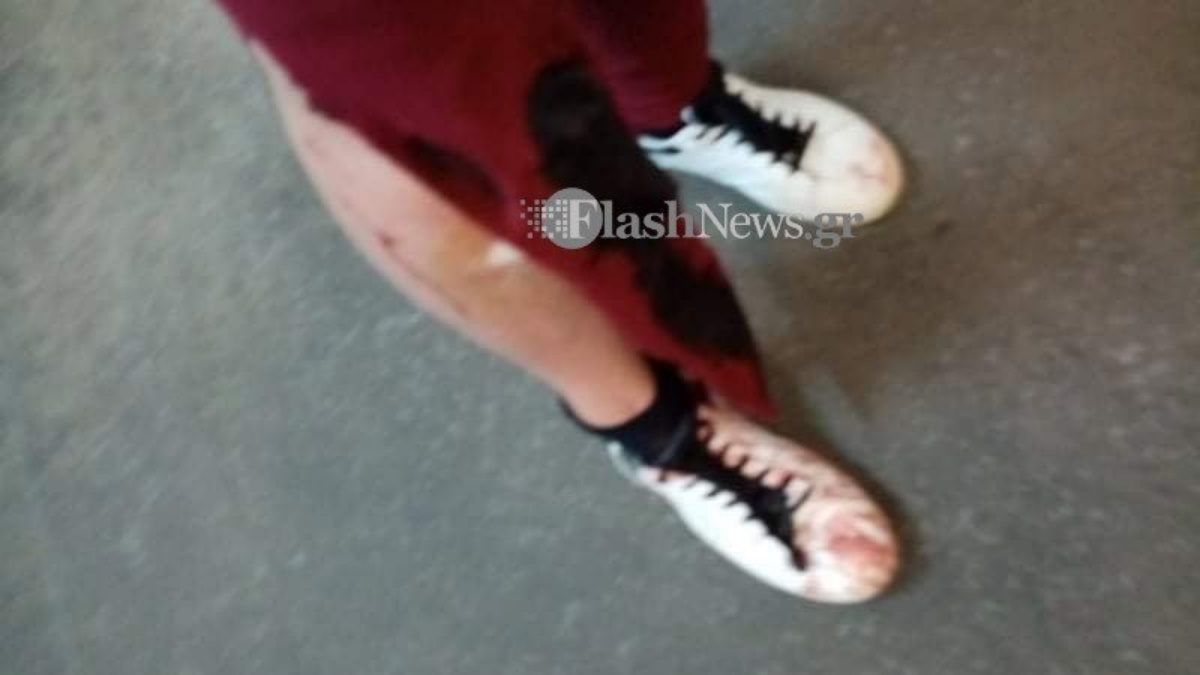 Κρήτη: Γυναίκα δέχθηκε επίθεση από σκυλιά – Καταγγελίες εις βάρος του ασυνείδητου ιδιοκτήτη (pics)