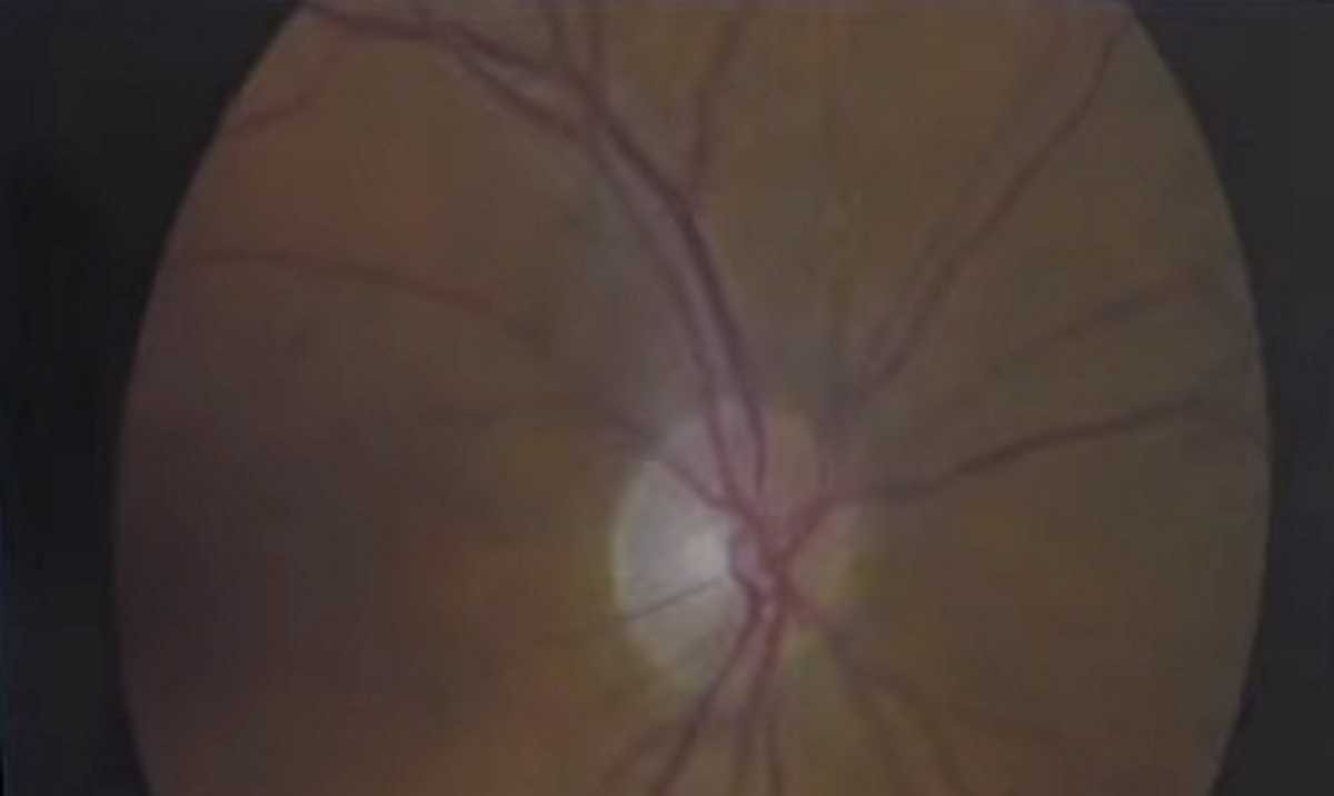 Γλαύκωμα: Ανακαλύφθηκαν 127 γονίδια κινδύνου για τα μάτια – Πάνω από 75 εκατ. οι πάσχοντες
