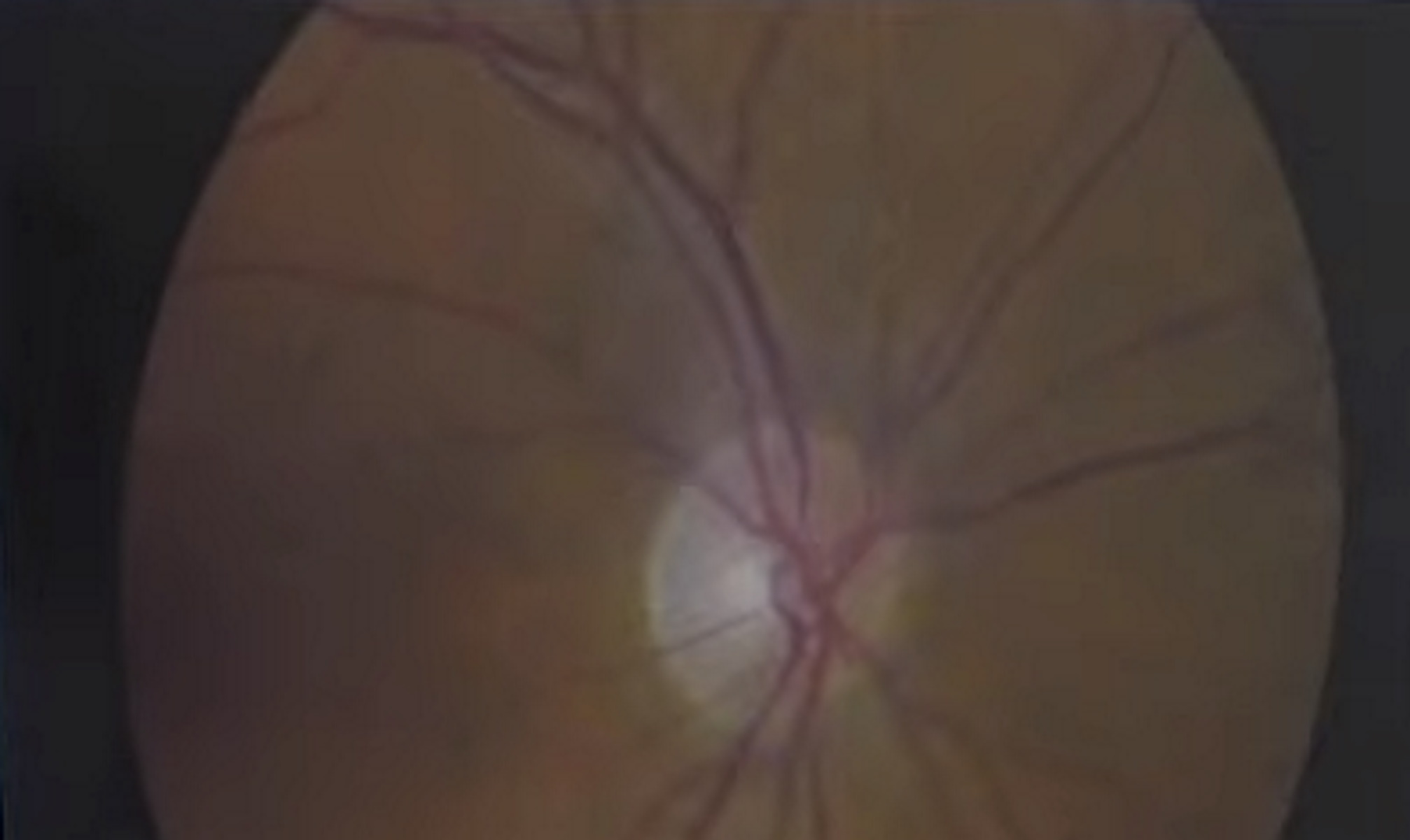 Γλαύκωμα: Ανακαλύφθηκαν 127 γονίδια κινδύνου για τα μάτια – Πάνω από 75 εκατ. οι πάσχοντες