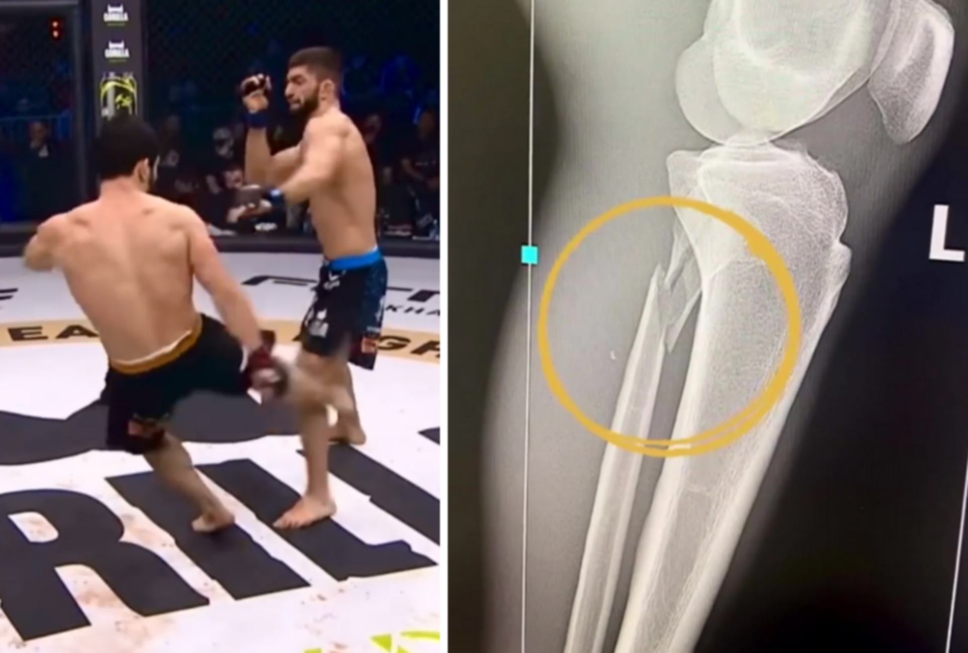 Αθλητής του ΜΜΑ έσπασε το πόδι του στο ρινγκ και γέλαγε (videos)