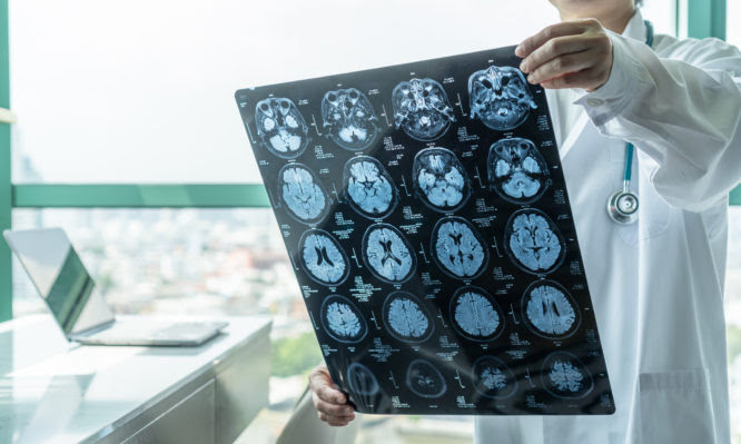 Brain disease diagnosis with medical doctor seeing Magnetic Resonance Imaging (MRI) film diagnosing elderly ageing patient neurodegenerative illness problem for neurological medical treatment