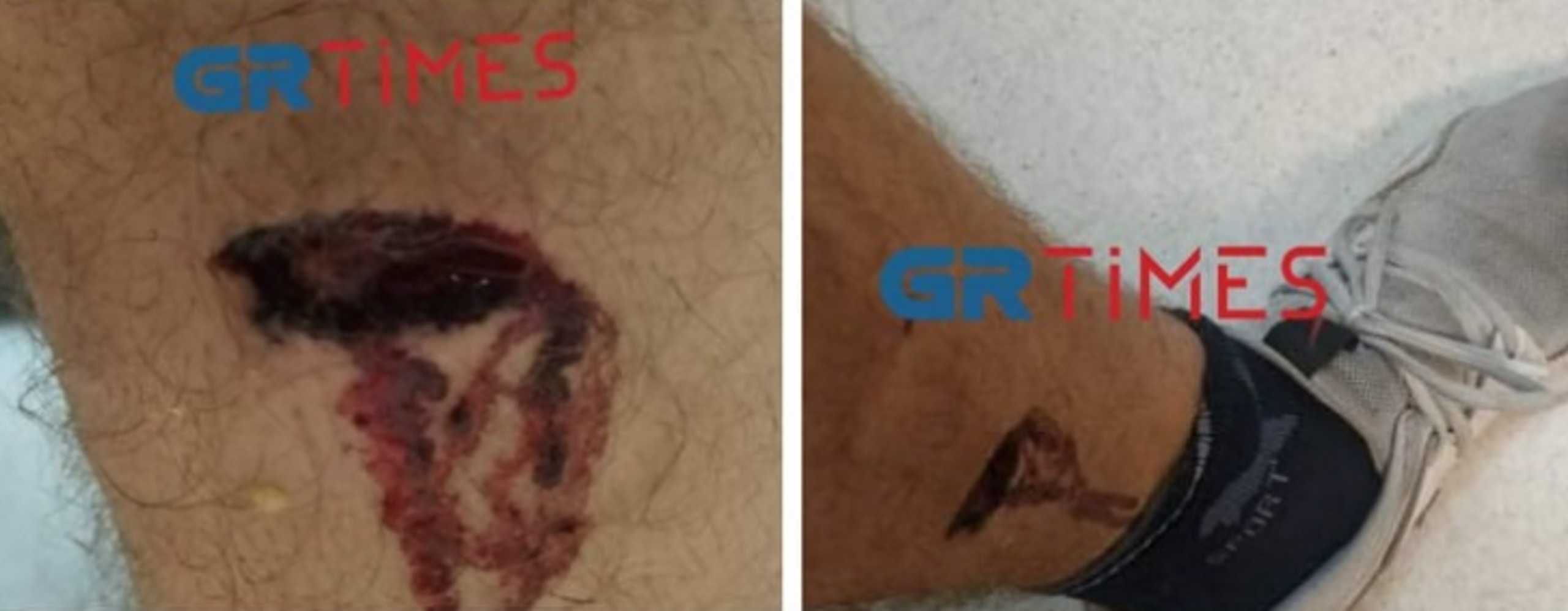 18 επιθέσεις από σκυλιά τον Οκτώβριο στη Θεσσαλονίκη – Νέο θύμα ένα ανήλικο κορίτσι
