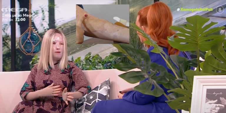 Ιωάννα Παλιοσπύρου: Αποκάλυψε τα σημάδια της από την επίθεση με βιτριόλι - Όταν έβγαλε τη μάσκα...