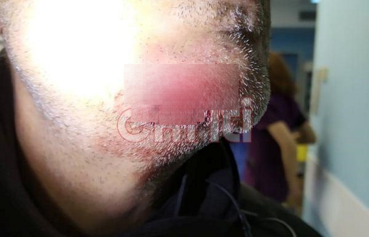Κρήτη: Δάγκωσε αστυνομικό που προσπάθησε να του κάνει έλεγχο – Έκοψε κομμάτι από το πιγούνι του