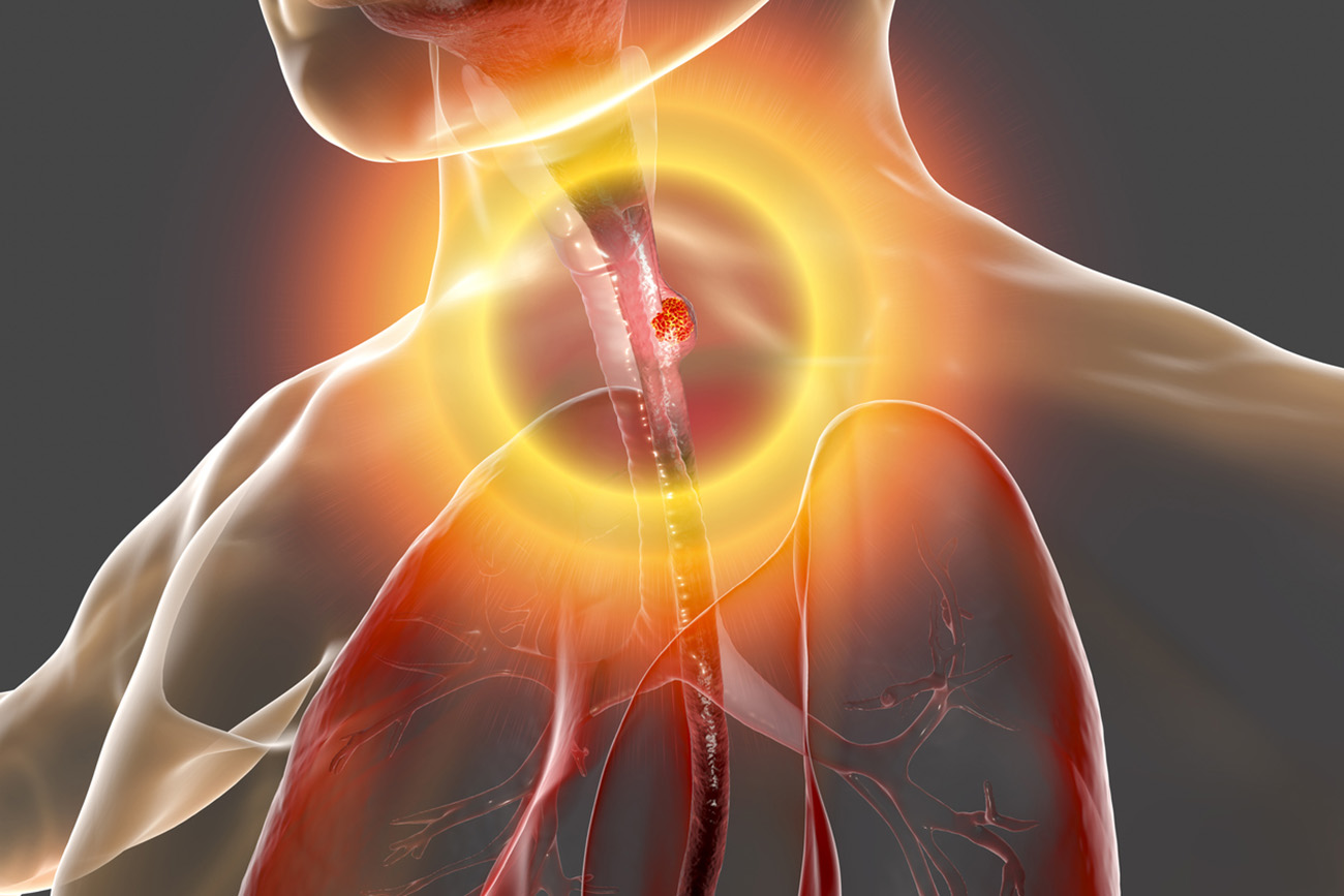 Esophageal cancer, 3D illustration showing malignant tumor in the human esophagus