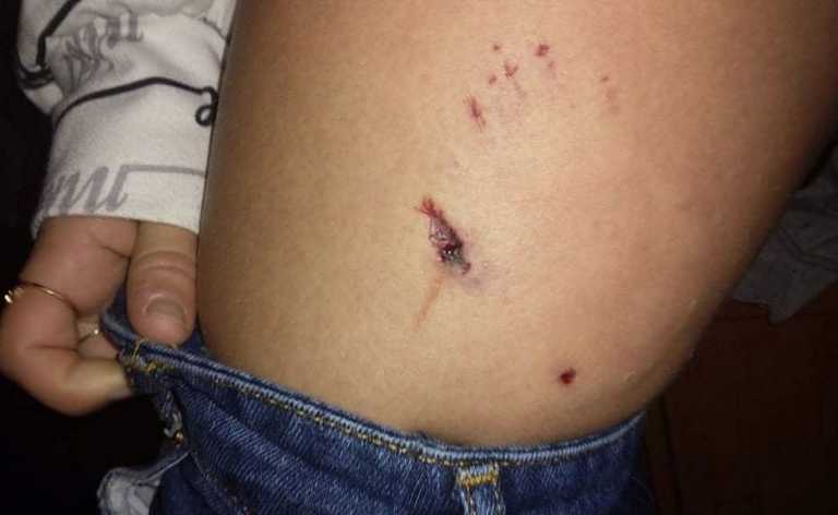 Χαλκιδική: Αδέσποτος σκύλος δάγκωσε 14χρονη στο πόδι