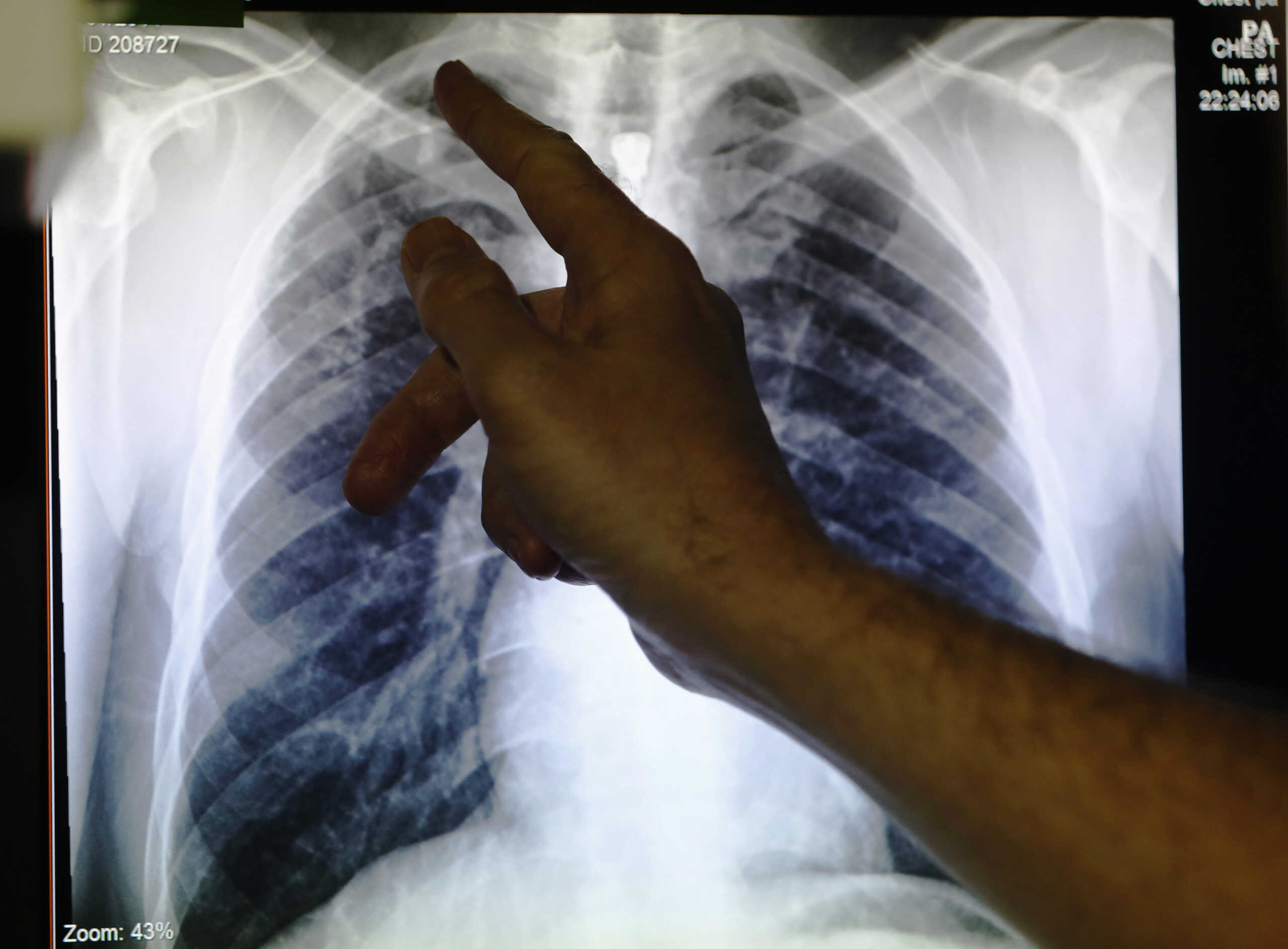 Καρκίνος του πνεύμονα: Διαγνωστικό εργαλείο του ΑΠΘ θα τον ανιχνεύει σε πρώιμο στάδιο