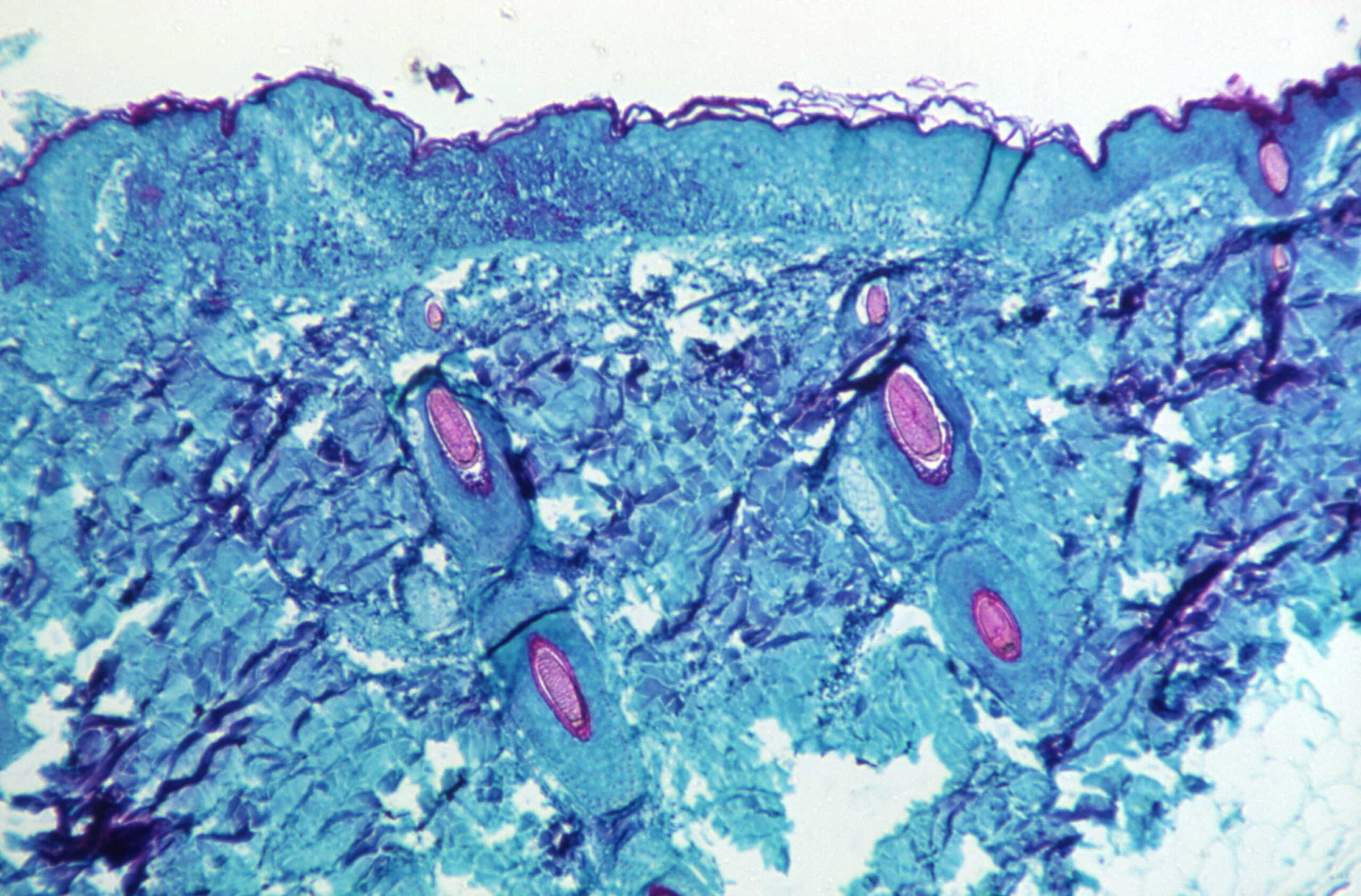 A section of skin tissue, harvested from a lesion on the skin of a monkey, that had been infected with monkeypox virus, is seen at 50X magnification on day four of rash development in 1968. CDC