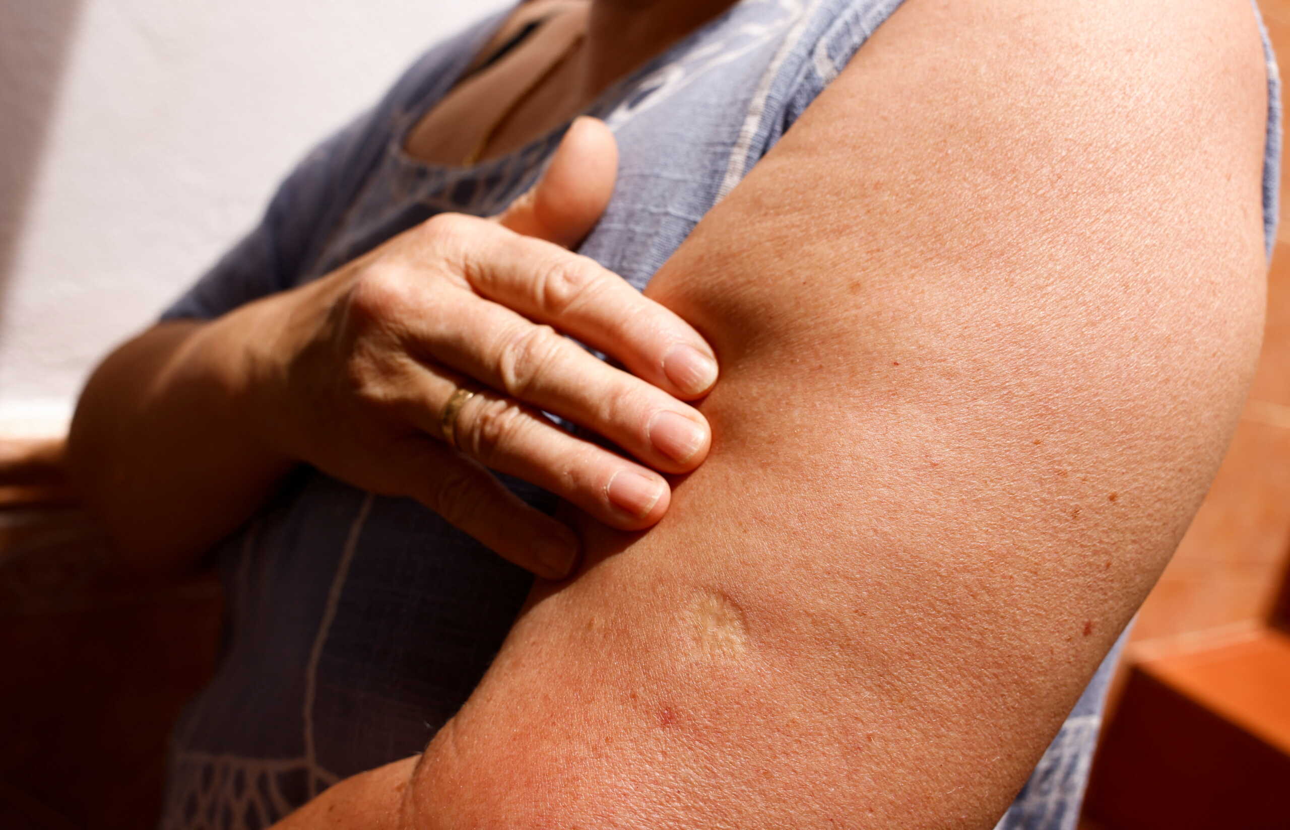Josefa Espinosa, 65, shows a scar on her arm from the vaccination against smallpox received during her childhood, in Ronda, Spain, May 25, 2022. REUTERS