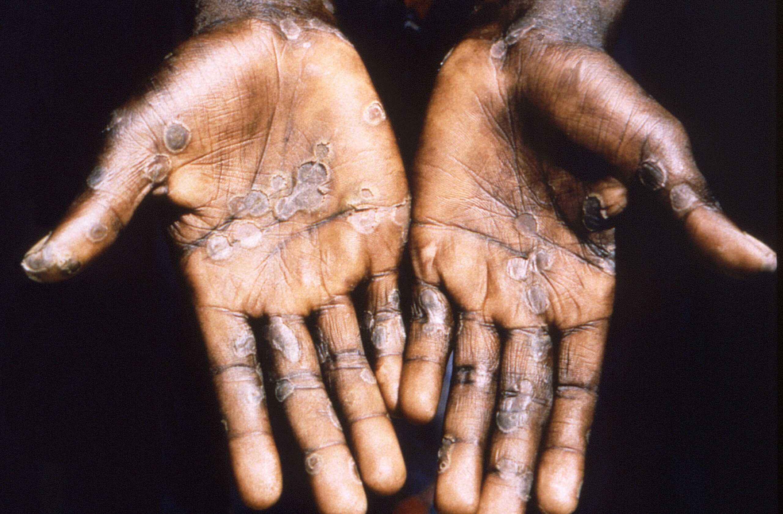 The palms of a monkeypox case patient from Lodja, a city located within the Katako-Kombe Health Zone, are seen during a health investigation in the Democratic Republic of Congo in 1997. Picture taken in 1997.  Brian W.J. Mahy