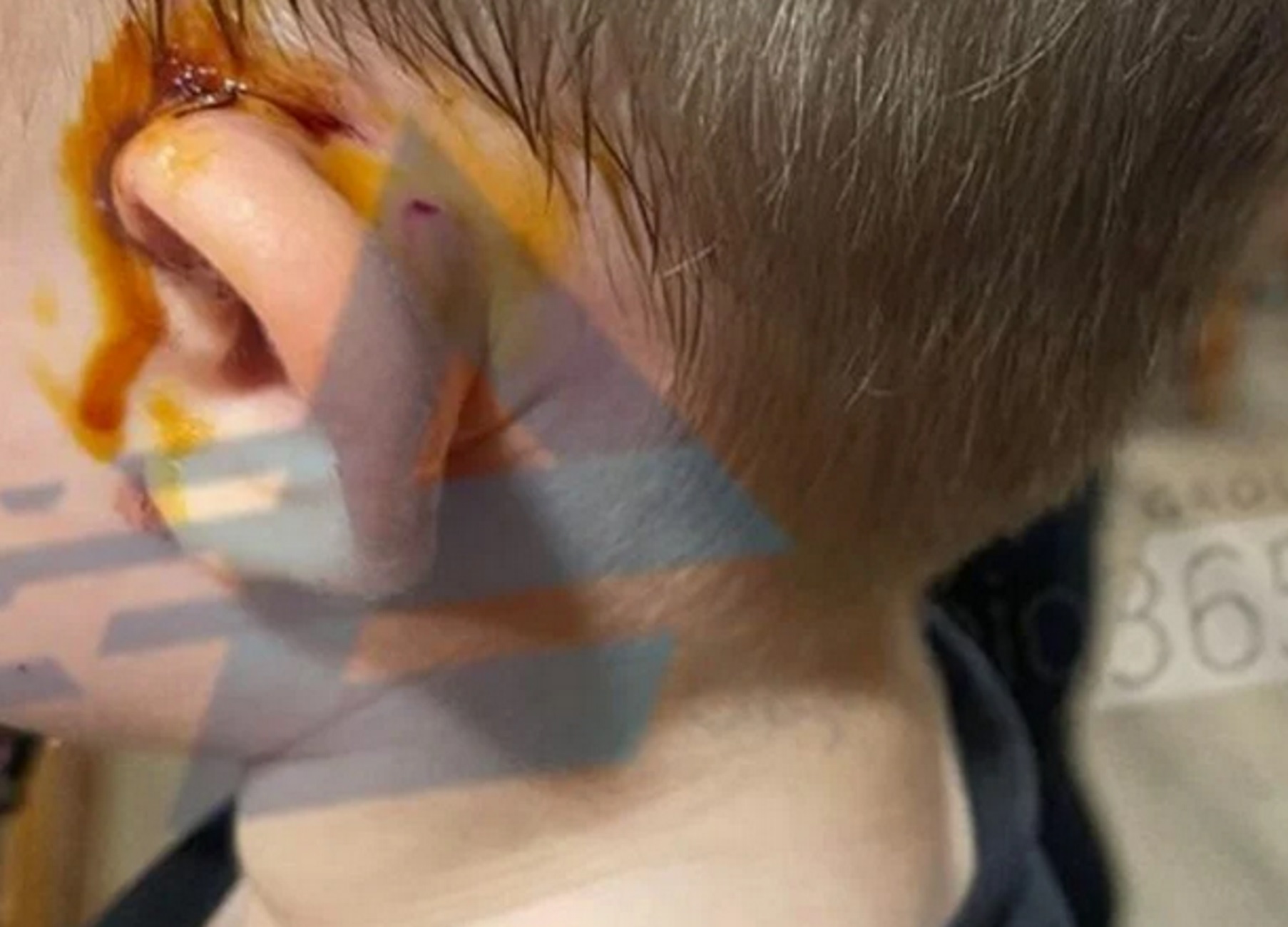 Αγρίνιο: Σκληρές εικόνες από επίθεση σκύλου σε παιδί 3 ετών – Πήδηξε και το δάγκωσε στο αυτί