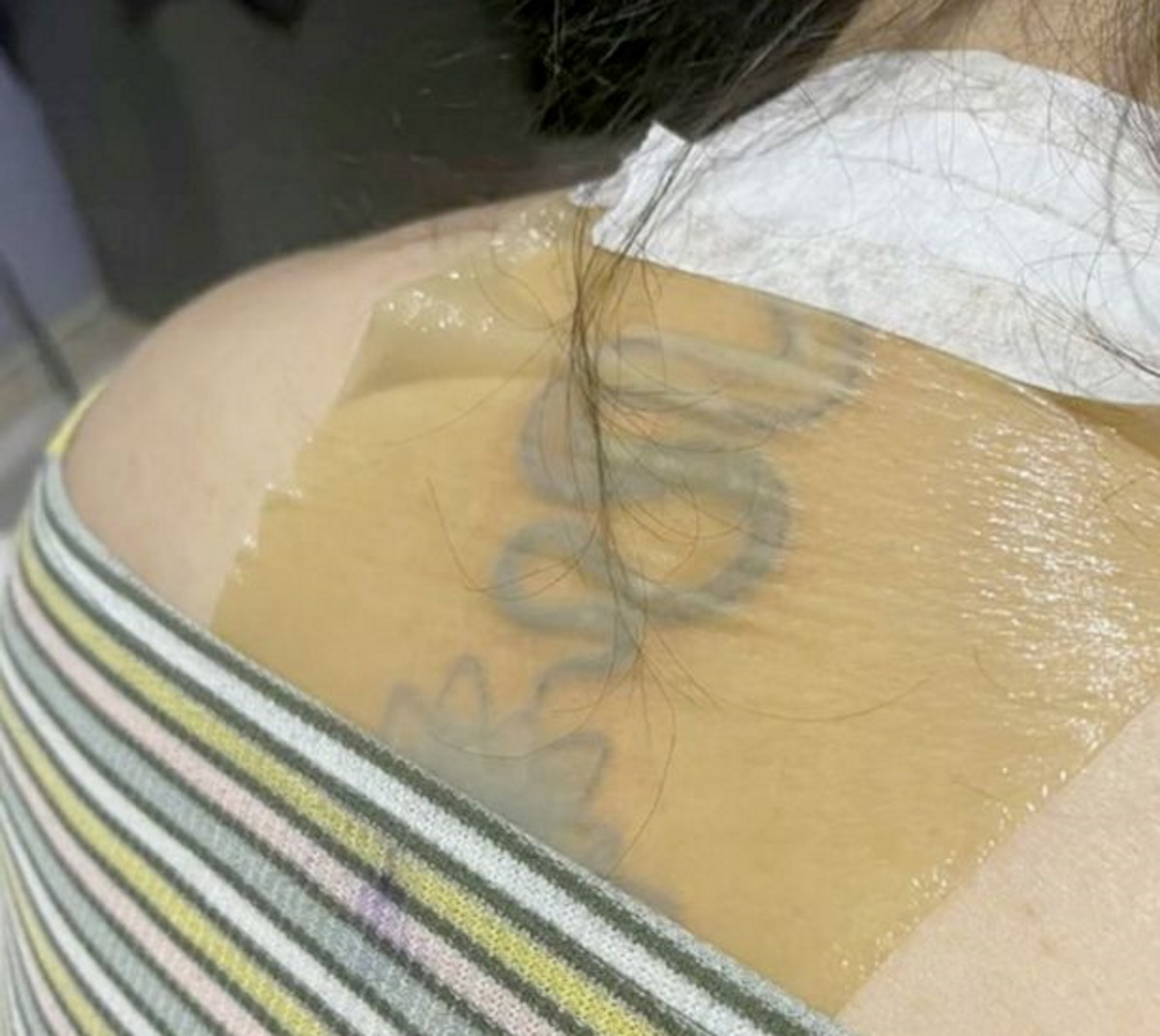 Αγνόησε τις οδηγίες και έκανε ηλιοθεραπεία – Το τατουάζ της φούσκωσε