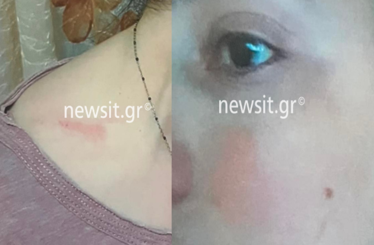 Θεσσαλονίκη: Εικόνες ντοκουμέντα της 29χρονης που κακοποιήθηκε οκτώ φορές από το σύζυγο της