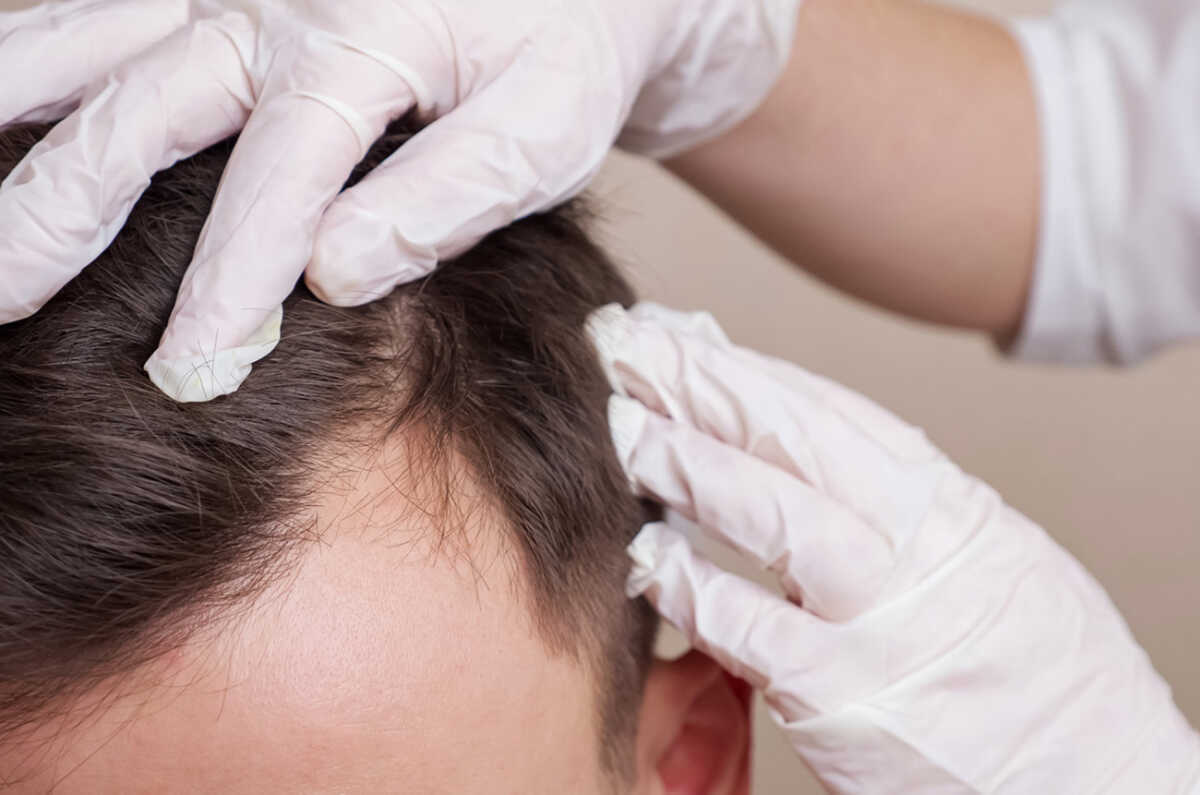 medical worker in gloves examines the head of a balding man close-up.