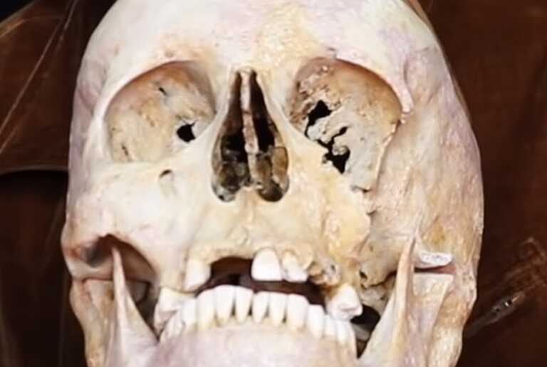 Η μυστήρια τρύπα σε αρχαίο κρανίο ανθρώπου – Σενάρια για χειρουργική επέμβαση εγκεφάλου πριν 3.500 χρόνια