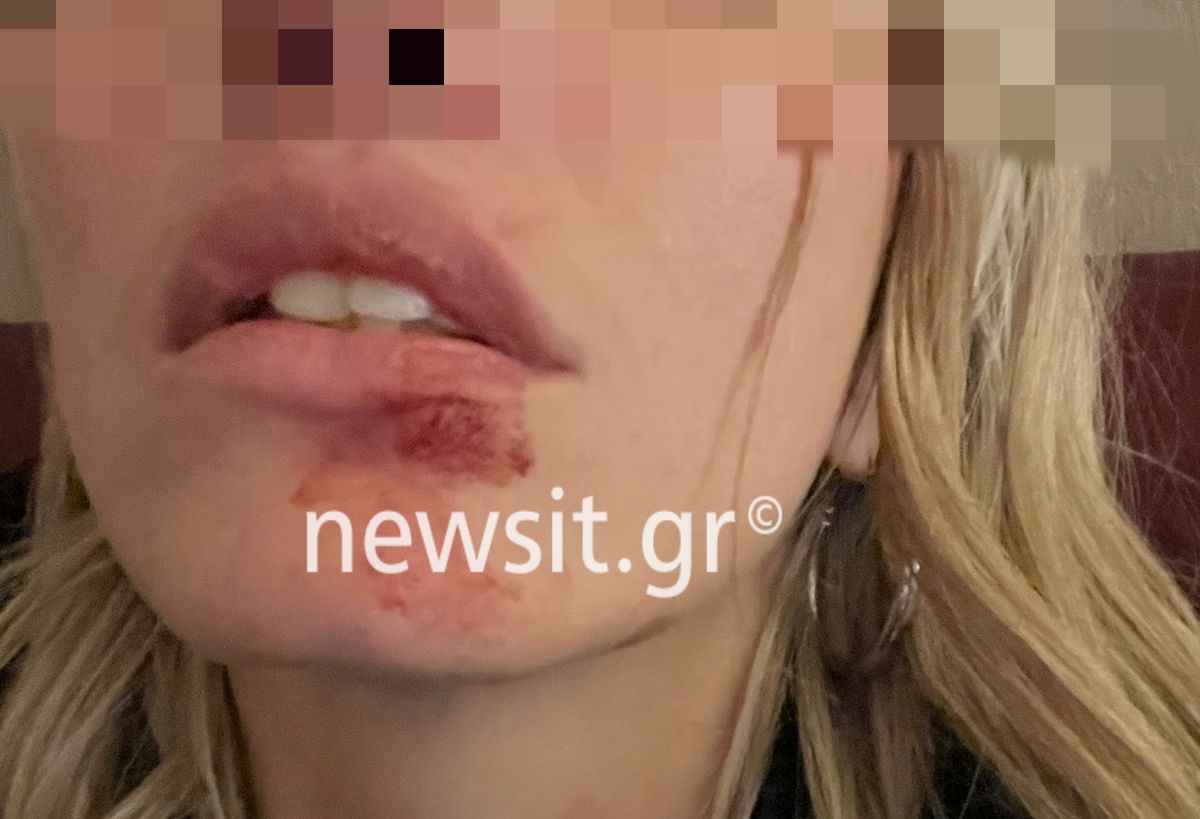 Φωτογραφίες ντοκουμέντο από τον ξυλοδαρμό που καταγγέλλει μοντέλο από τον πρώην σύντροφό της