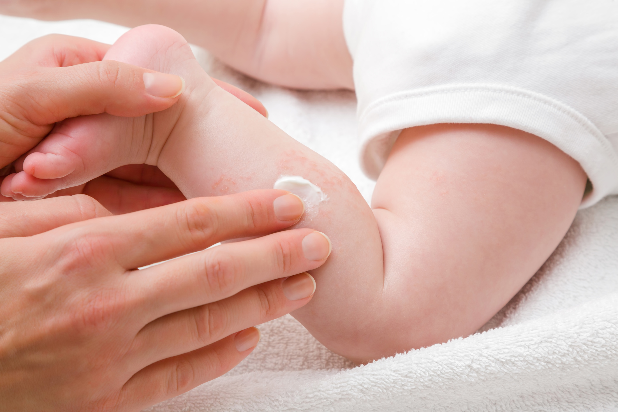 Woman hand holding infant leg. Mother carefully applying medical ointment. Red dry skin allergy from milk formula or other food. Care about baby body. Closeup.