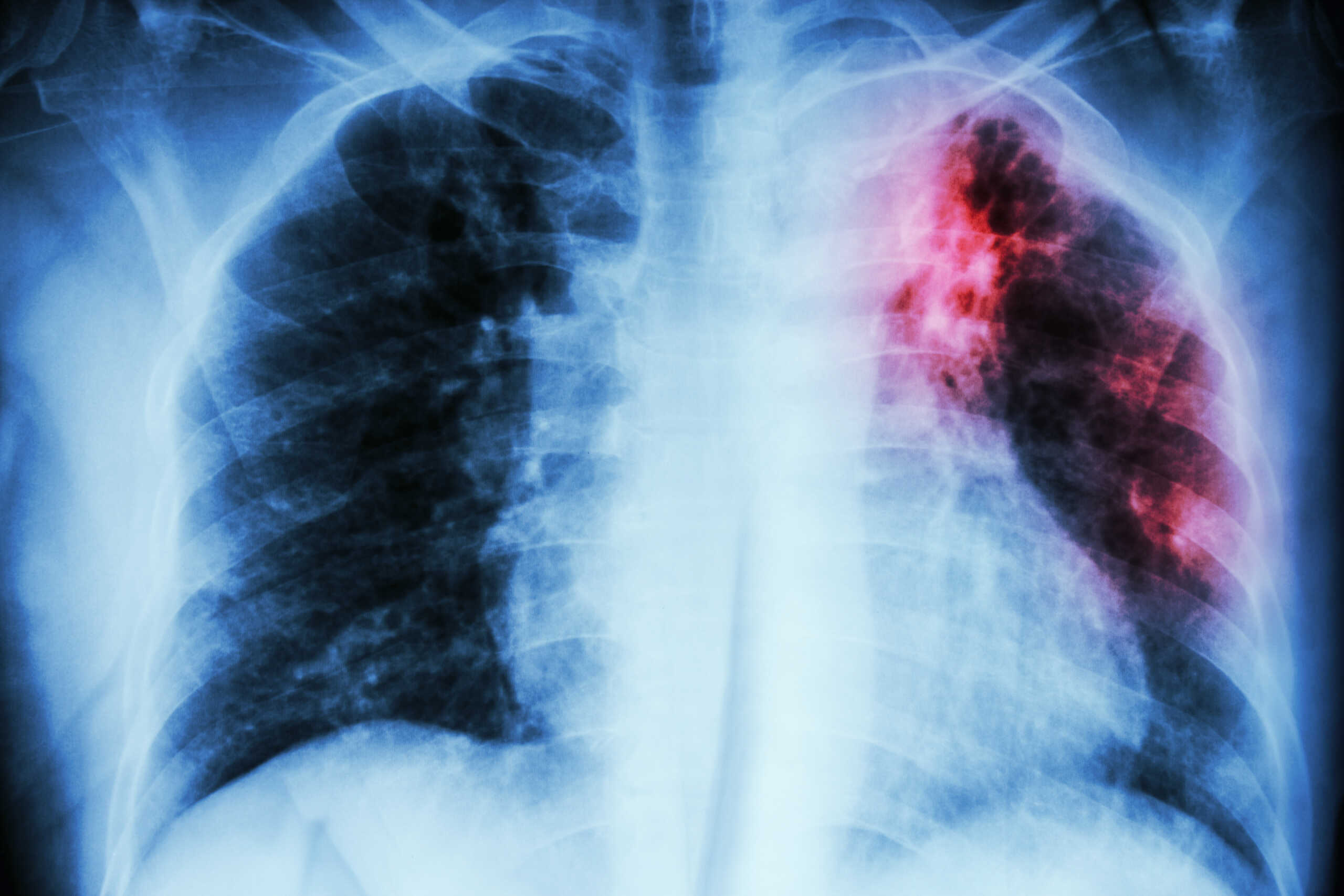 Pulmonary Tuberculosis .  Chest X-ray : interstitial infiltration at left upper lung due to Mycobacterium Tuberculosis infection