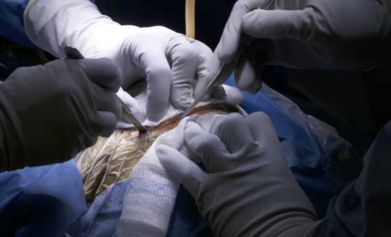 Χειρούργησαν εγκέφαλο εμβρύου στη μήτρα της μαμάς - Πρωτοποριακή επέμβαση έσωσε αγέννητο μωρό στη Βοστώνη