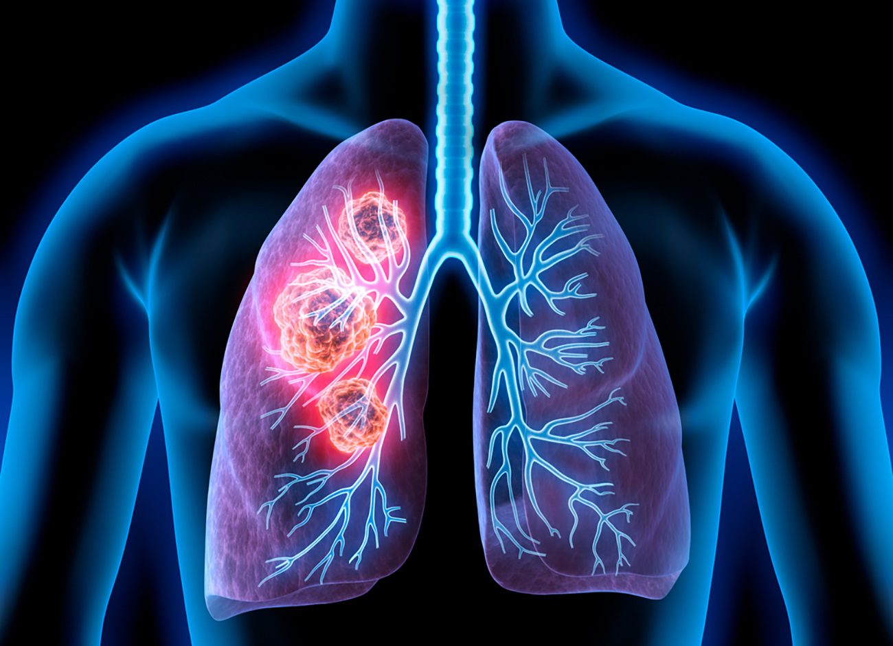 Medical Illustration of lung cancer - cancerous area in lungs