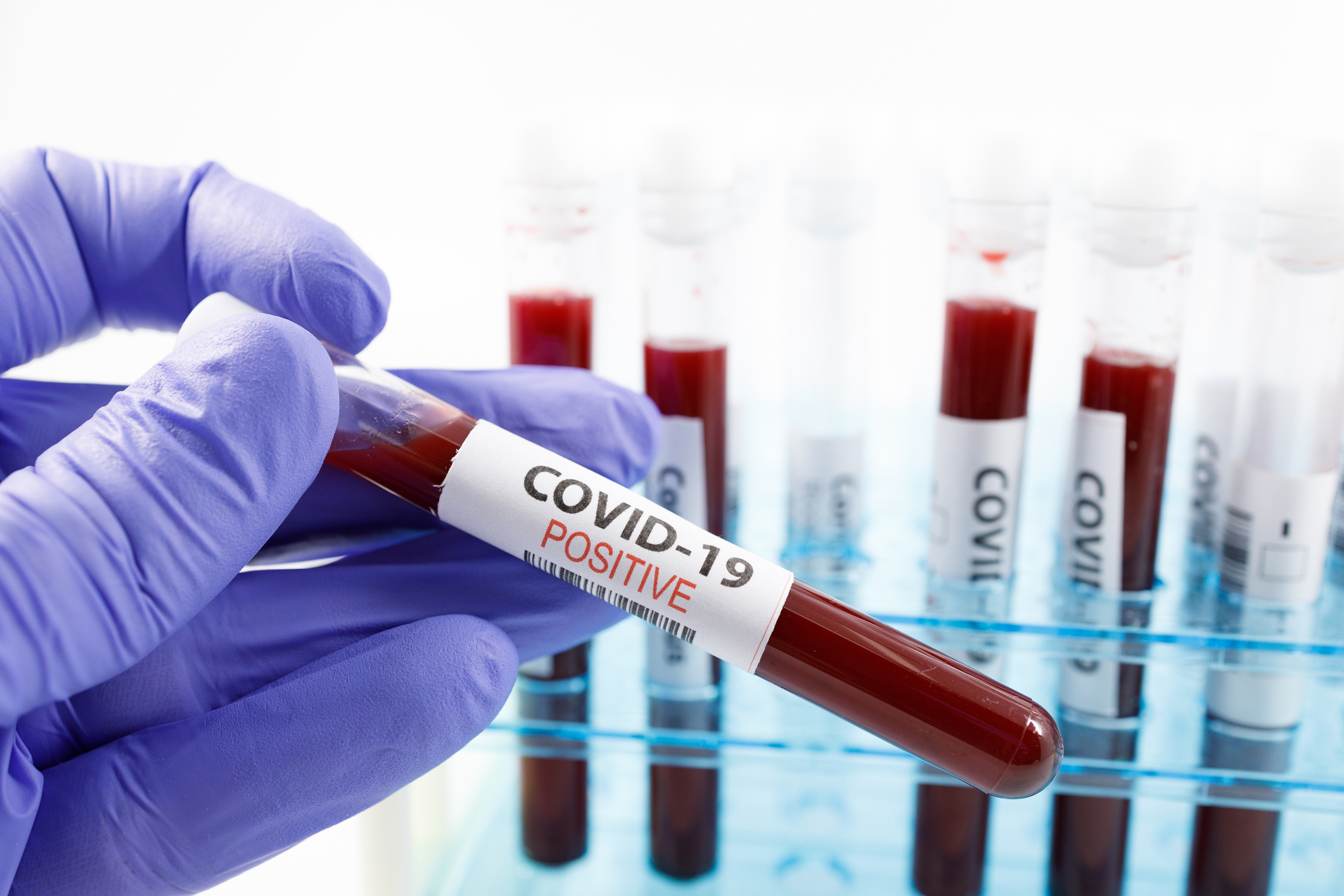 Κορονοϊός: Εξέταση αίματος εντοπίζει με ακρίβεια τους ασθενείς με long covid