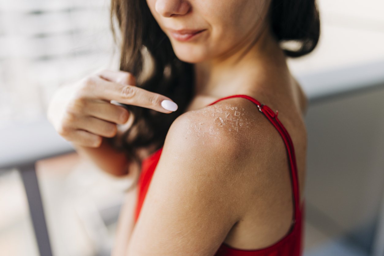 Females sunburned back