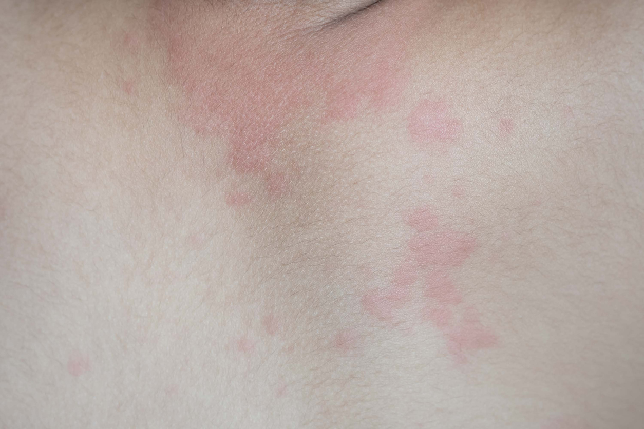 Close up image of boy's body suffering severe urticaria, nettle rash.